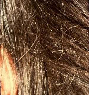 Гниды на длинных волосах