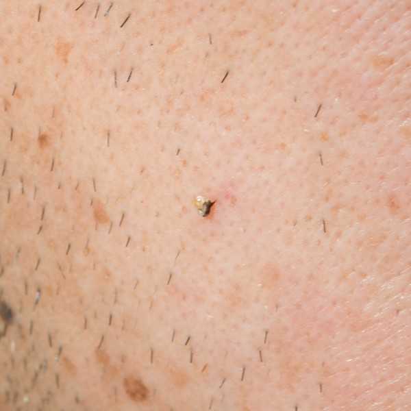 WithoutAllergyКрапивница от укусов насекомых признаки и что с этим делать