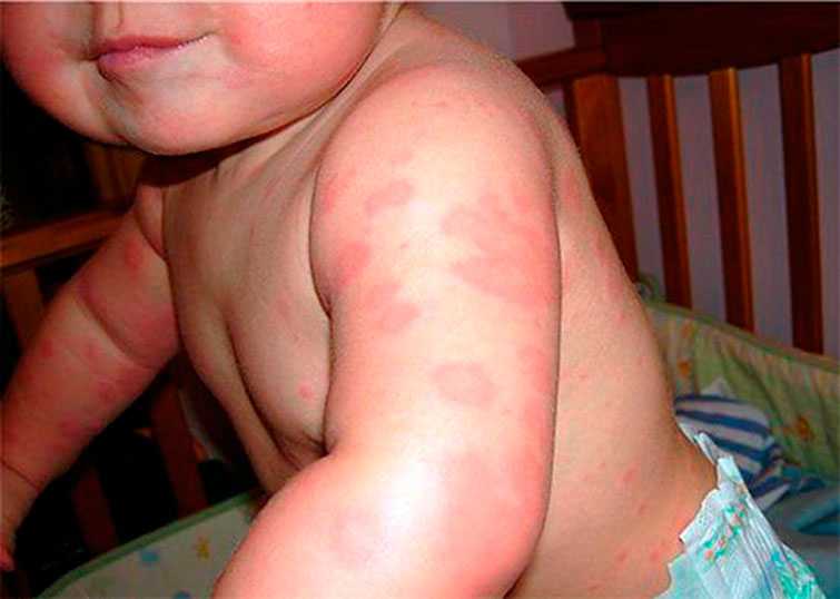 Как определить аллергию на клопов и что делать