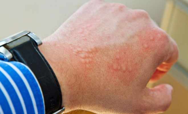 Аллергия на укус клопов